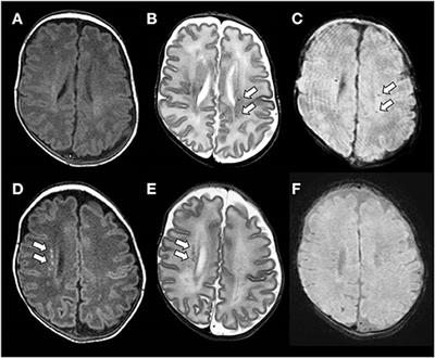Nosological Differences in the Nature of Punctate White Matter Lesions in Preterm Infants
